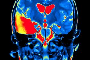 Storytelling - MRI Brain Scan